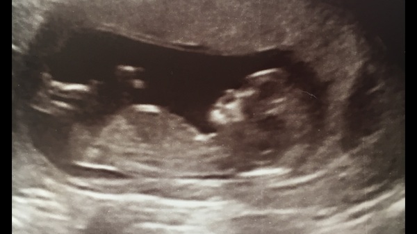 Boy or Girl