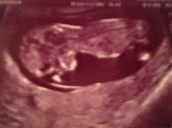 Due in June, 12 week scans happening and coming up!