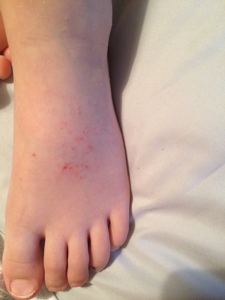 What is this rash?