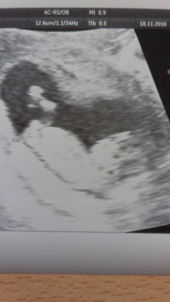 Gender guesses? 12 weeks