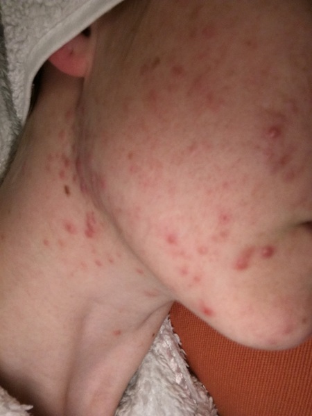 Adult acne - help me!