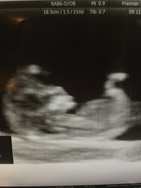 Nun theory - 11 weeks scan