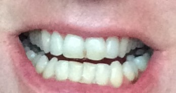 Discoloured front tooth (pic)