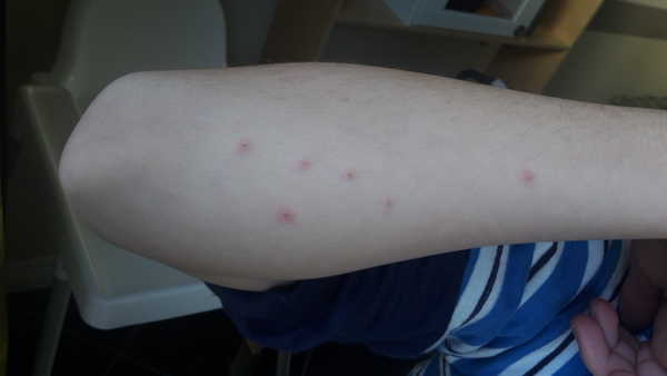 Spots / rash