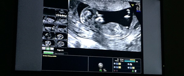 What do people think, boy or girl?