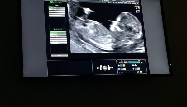 What do people think, boy or girl?
