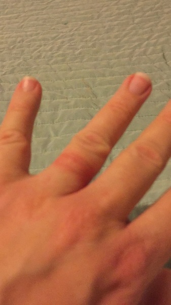 Manky finger!!