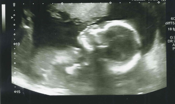 April 2017 #5 - second trimester! Less feeling crap, more feeling kicks