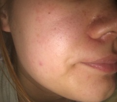 Skincare advice please? Combination/Rosacea skin.