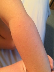 What is this rash?