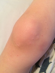 What is this rash?