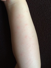 Rash