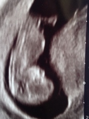Gender scan this Saturday- anyone fancy a guess?