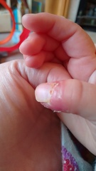 How to treat DSs thumb
