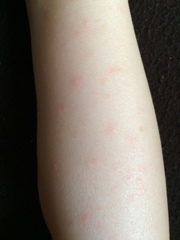 Rash