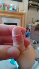 How to treat DSs thumb