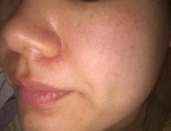 Skincare advice please? Combination/Rosacea skin.
