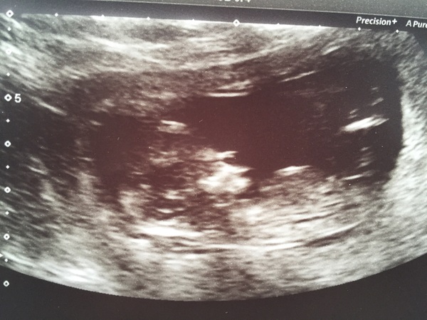 Due in June, 12 week scans happening and coming up!