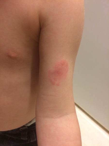 Or is my DH regarding our son being bitten at Nursery.