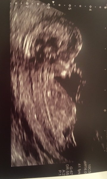 May 2017 #5 - 20 week scans and pram buying plans