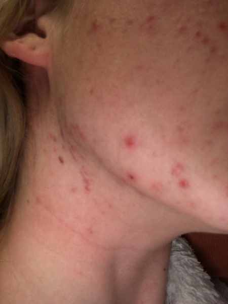Adult acne - help me!