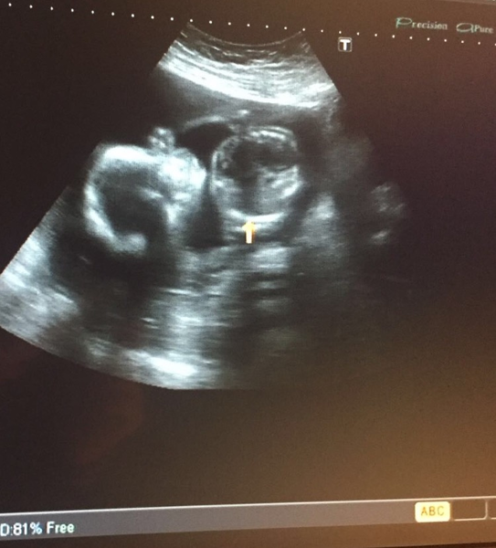 May 2017 #5 - 20 week scans and pram buying plans