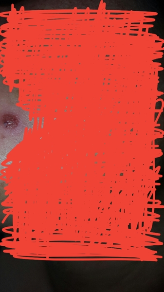 Help me deal with this monstrosity of a spot on my face