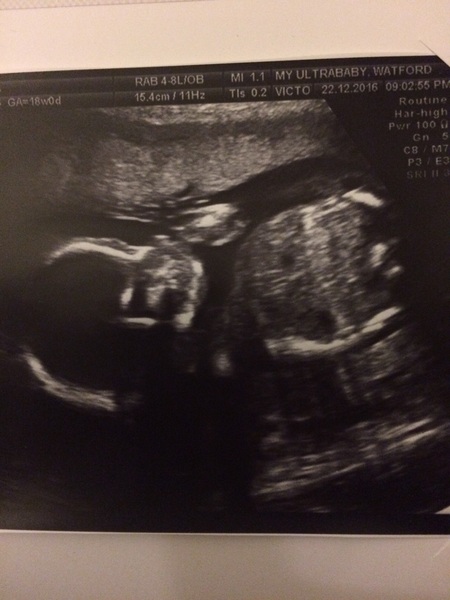 May 2017 #5 - 20 week scans and pram buying plans