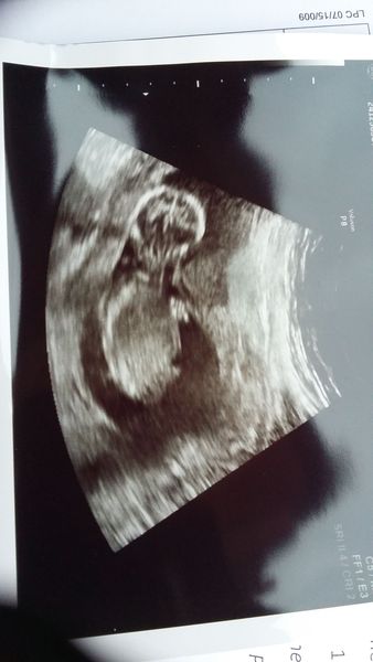 Due in June, 12 week scans happening and coming up!