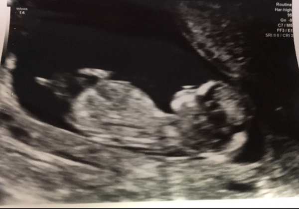 Due in June, 12 week scans happening and coming up!