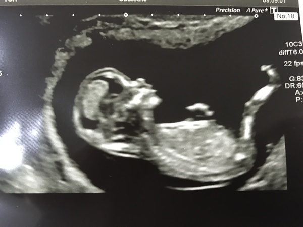 13 weeks 2 days scan- boy or girl?