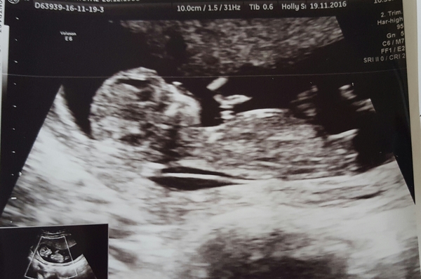 Another guess ifs its a boy/girl post