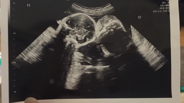 Pregnancy after infertility III