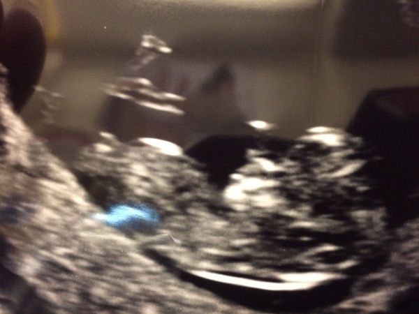 Due in June, 12 week scans happening and coming up!