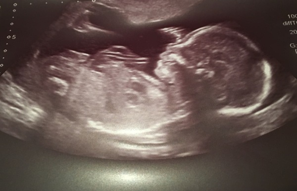 May 2017 #5 - 20 week scans and pram buying plans