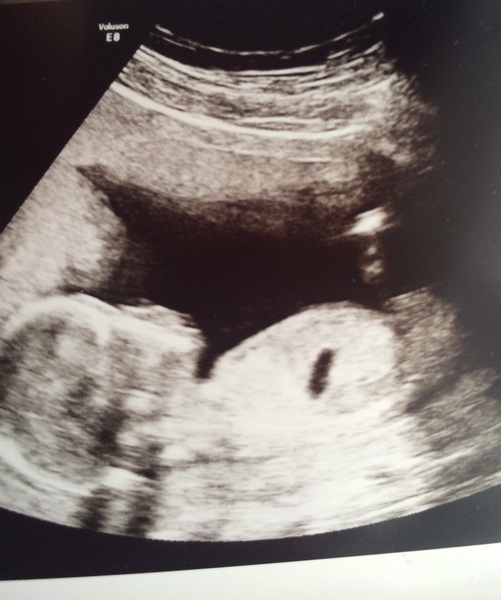 12 week scan, gender guesses?