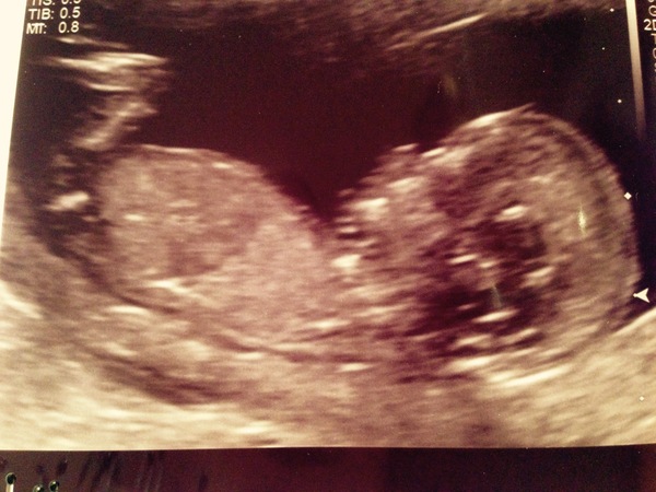 Due in June, 12 week scans happening and coming up!