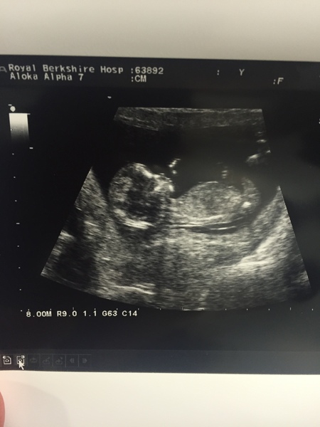 Just for fun, 12 week scan boy or girl