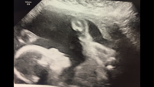 Pregnancy after infertility III