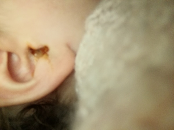 Perforated Ear drum on a Sunday