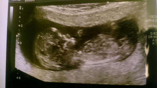 Due in June, 12 week scans happening and coming up!