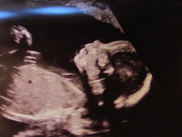 May 2017 #5 - 20 week scans and pram buying plans