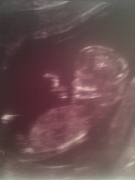 Due in June, 12 week scans happening and coming up!