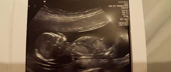 Is this scan suitable for Nub theory?