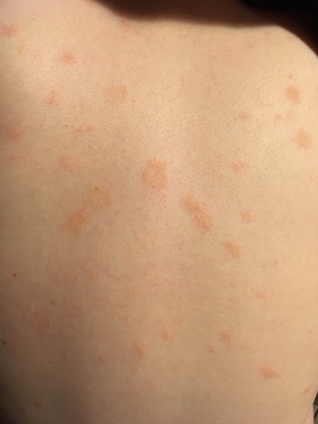 Dr Mumsnet diagnose this rash