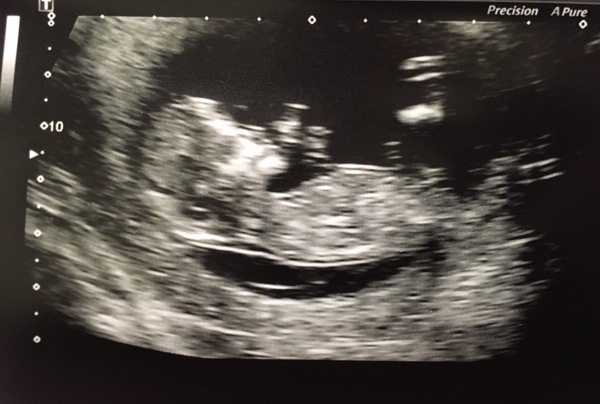 Due in June, 12 week scans happening and coming up!