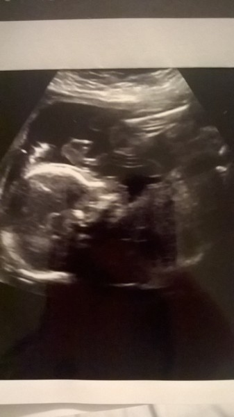 sonographer unsure of sex