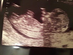 Scan photo-does this look boy or girly nub?