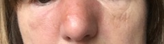 Cellulitis