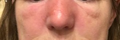 Cellulitis